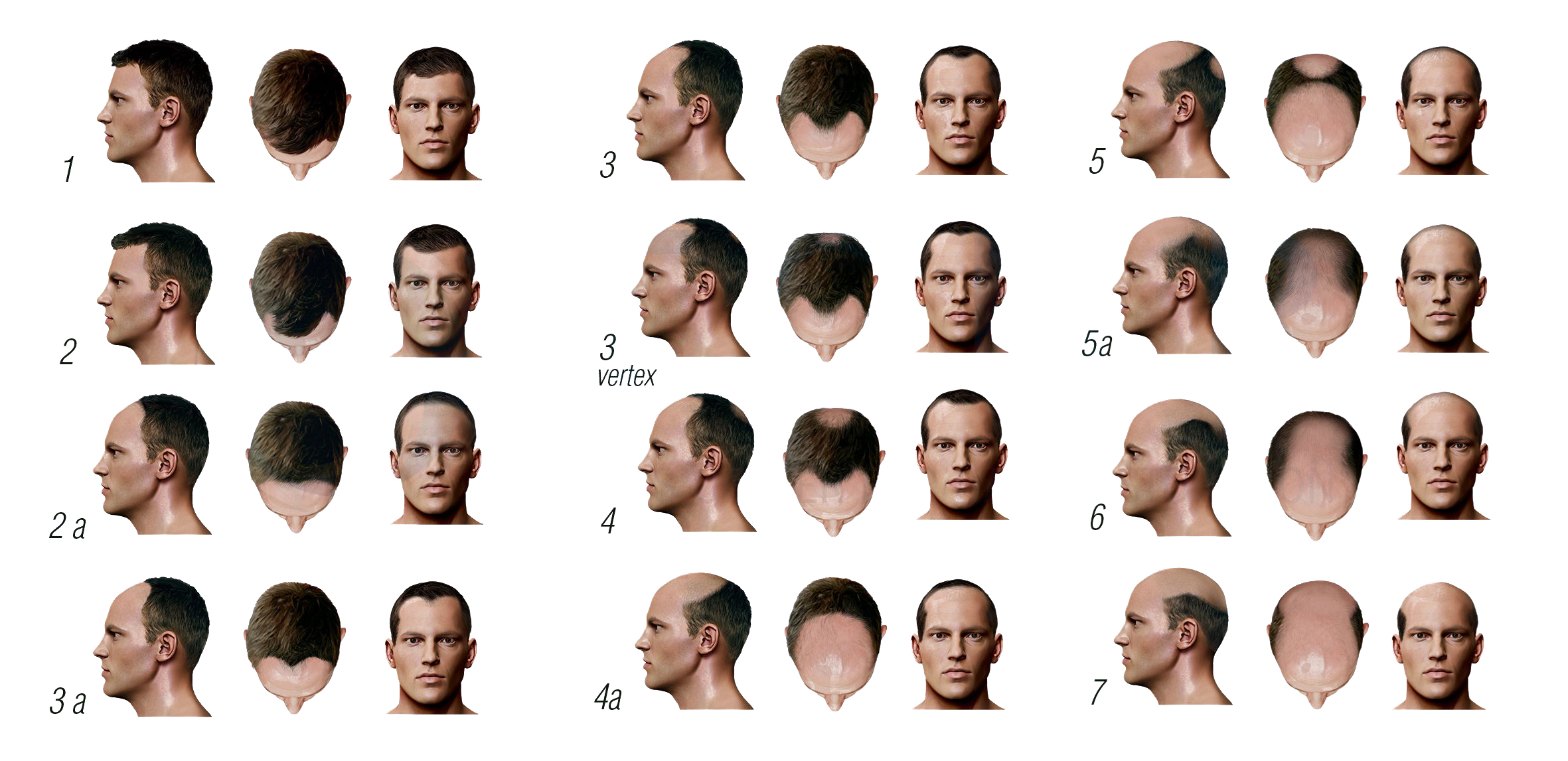 Classification of Hair Loss in Men | Maral Hair