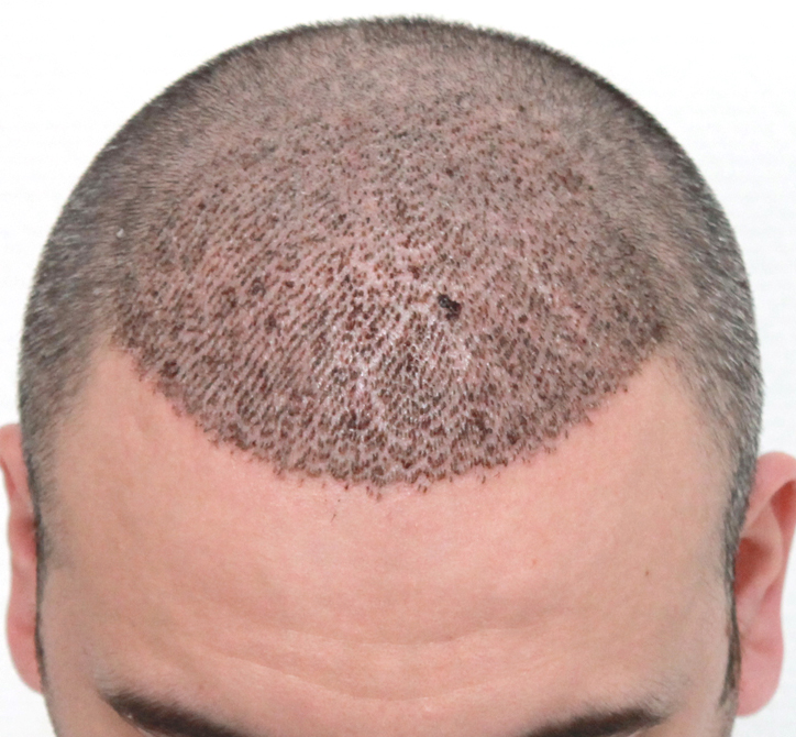 What are the benefits of Hair Transplant? - Apollo Cosmetic Clinics