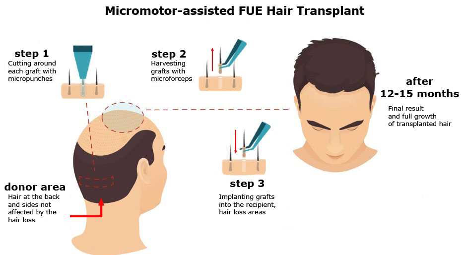 Hair Transplantation Techniques | Maral Hair