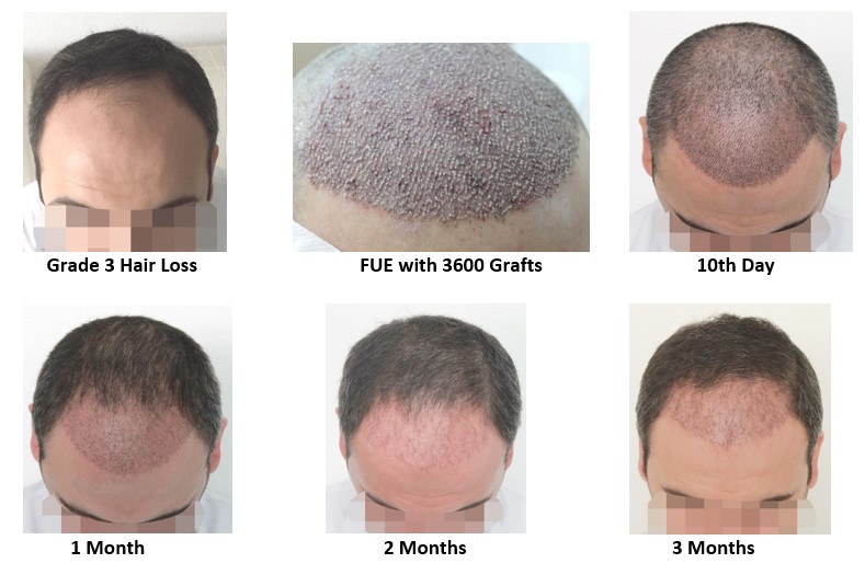 Are FUE hair transplants dangerous? Read this before you get one - Bangkok  Hair Clinic