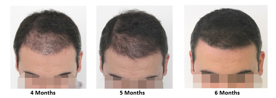 Six Months After Hair Transplant Surgery Stock Photo - Download Image Now -  Completely Bald, Senior Adult, Hair Transplant - iStock