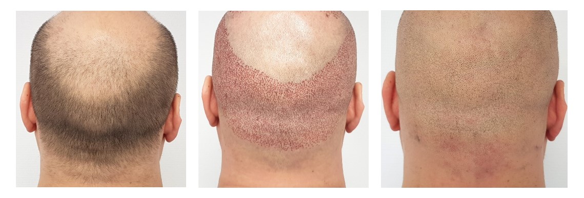 How to Remove Scabs after a Hair Transplant? - Regrow