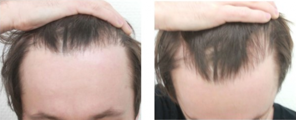 Before the FUE Hair Transplant | Maral Hair